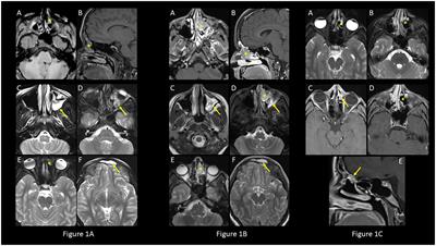 An adolescent girl with syndrome of inappropriate antidiuretic hormone secretion preceding the diagnosis of olfactory neuroblastoma – a case report